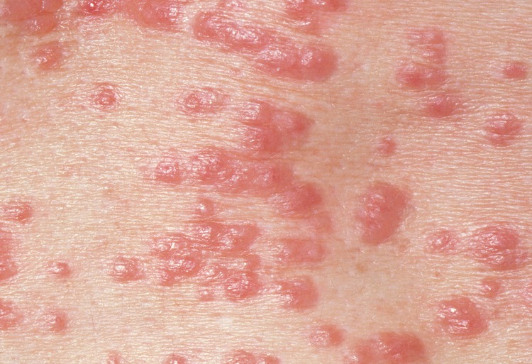 Gross Conditions Molluscum Contagiosum