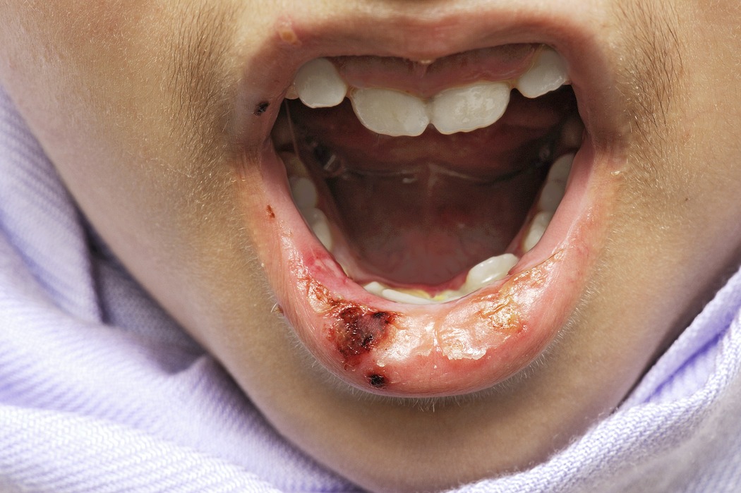 Gross Conditions Cold Sores