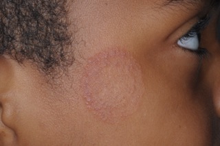 Gross Conditions Ringworm On Boys Cheek