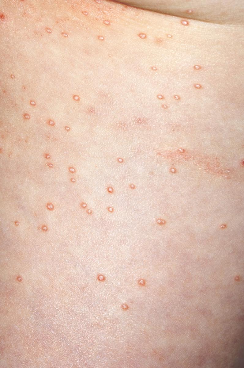 Gross Conditions Scabies